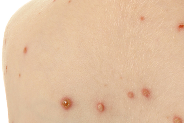 膿痂疹の家庭療法